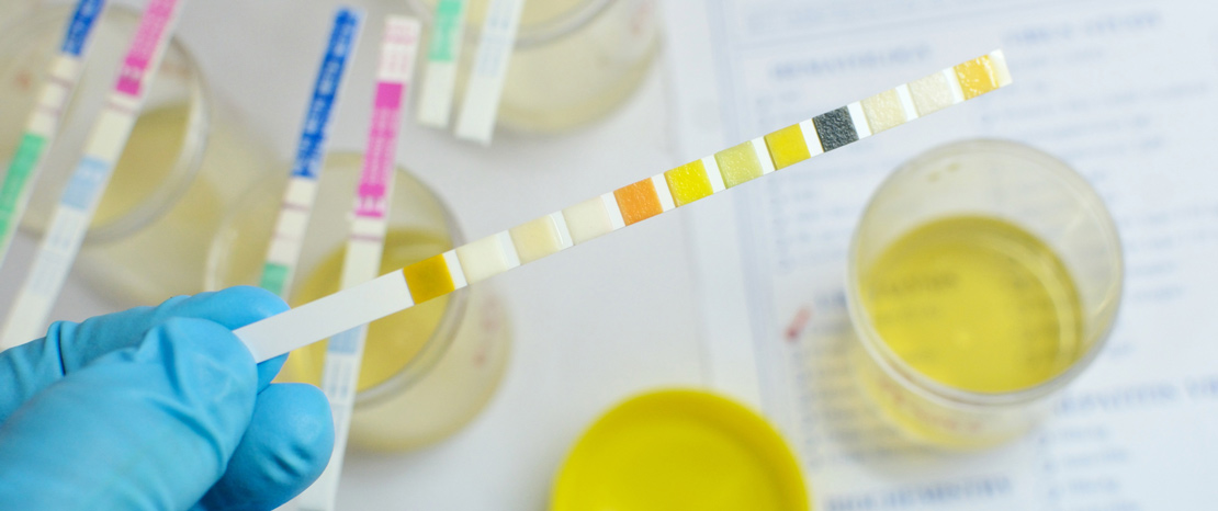 Urine sample with test strip identifier.   Medical laboratory sampling sites are located in Boise, Garden City, Meridian, Idaho Falls, Pocatello and Rexburg 